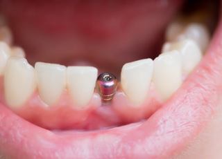 Single implant post in row of teeth