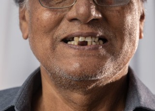 Man’s smile misses a few teeth