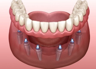 Illustration of implant dentures