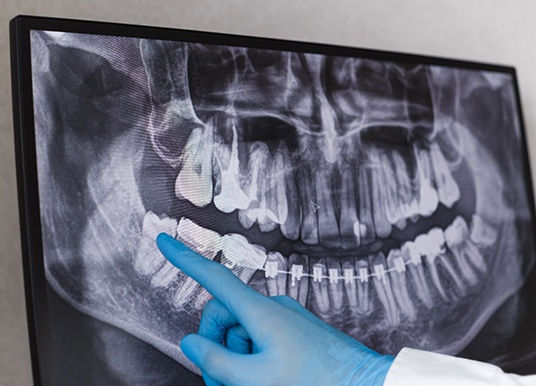 a dentist pointing at wisdom teeth in an X-ray