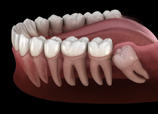 a computer graphic showing a wisdom tooth growing in sideways