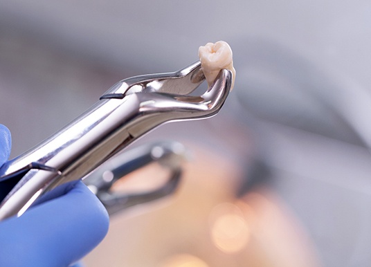 dental forceps holding an extracted wisdom tooth